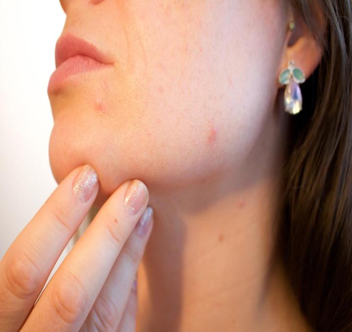 acne-1606765_1280_0.jpg